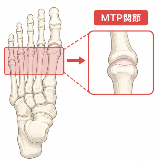 MTP関節